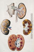 Diseases of the kidneys, from 'Anatomie Pathologique du Corps Humain' - Antoine Chazal
