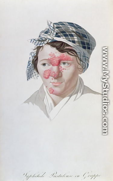Syphilic cluster pustules, from a book by Baron Jean Louis Alibert 1768-1837 1838  - Salvadore Tresca