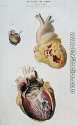 Plate depicting heart diseases. Spontaneous rupture of the heart of an 86 year old woman (fig. 1) and pericarditis in a six day old baby (fig. 2), from 'Anatomie pathologique du corps humain', 1828-42 - Antoine Chazal