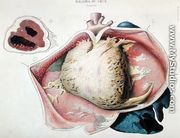 Pericarditis, plate depicting heart diseases from 'Anatomie pathologique du corps humain' - Antoine Chazal