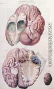 Cancerous tumours of the brain, from 'Anatomie Pathologique du Corps Humain' - Antoine Chazal