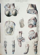 Diseases of the joints, from 'Anatomie Pathologique du Corps Humain' - Antoine Chazal